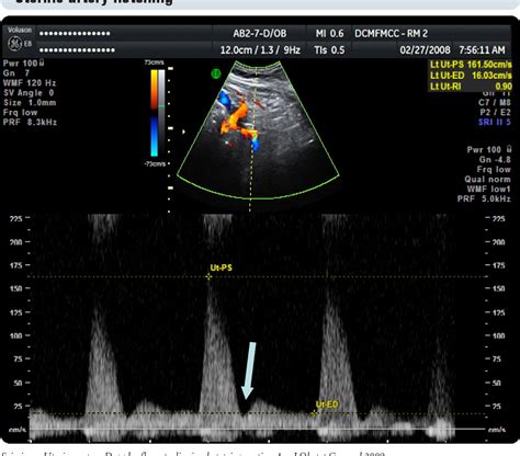 doppler maternaler gefäße|Uterine artery Doppler flow studies in obstetric practice